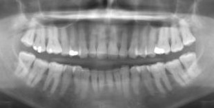 Radiographie panoramique 2D